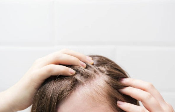 Perte de cheveux - Femme
