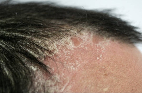 Psoriasis